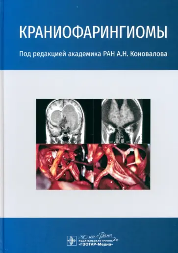 Александр Коновалов - Краниофарингиомы Александр Коновалов - Краниофарингиомы обложка книги