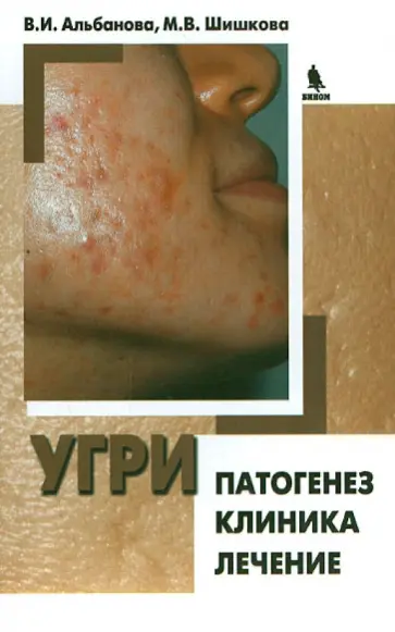Альбанова, Шишкова - Угри. Патогенез. Клиника. Лечение обложка книги