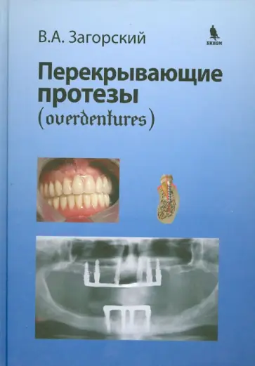 Валерий Загорский - Перекрывающие протезы (overdentures) обложка книги